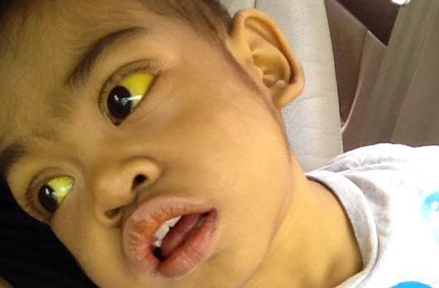 Arshad been suffering from biliary atresia (a liver disease) since birth.