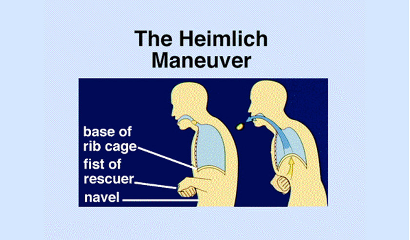 Manuver Heimlich