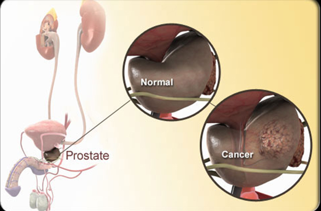 cancerous prostate
