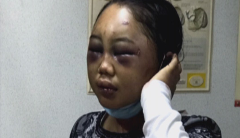 Suyanti was badly injured in the eyes, hands and legs and internal organs, suffered a blood clot under the skin on the head, bleeding spots in front of the brain, a broken cheek bone, jaw and left shoulder as well as injury to the right lung.