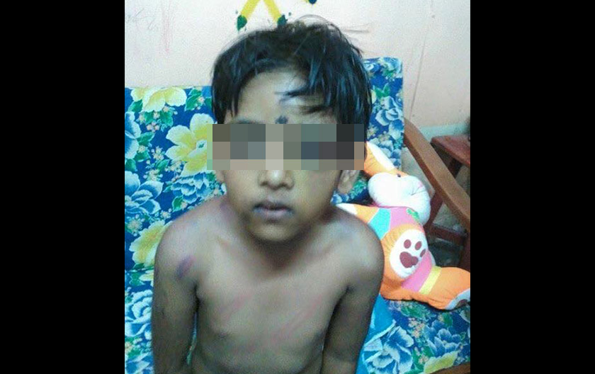 The severe bruises on the young girl's left eye. - Astro AWANI