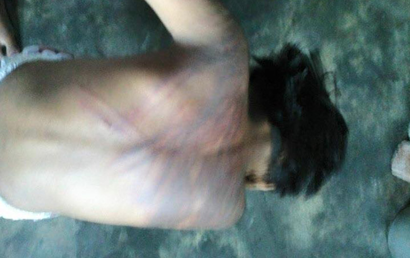 More abuse marks on the child's back. - Astro AWANI