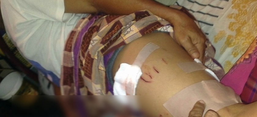 Photo caption: Shakawi was lucky that the crocodile only caught his thigh, as he fought it to free himself.