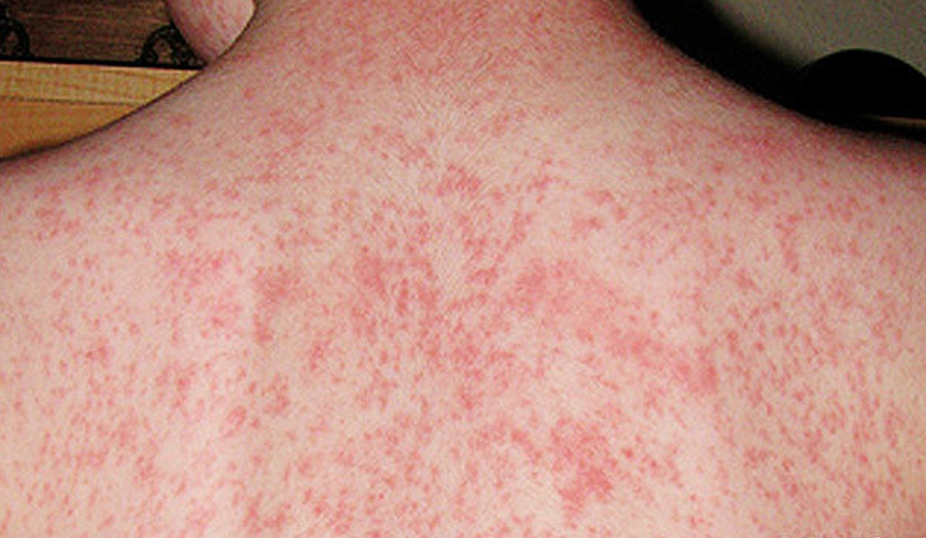 A total of 403 measles cases in Selangor have been reported in the first quarter of 2016.