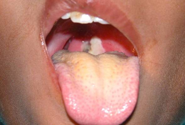 The victim was suspected to have diphtheria and was referred to the Tuanku Jaafar Hospital, Seremban where she was warded for treatment. -Filepix