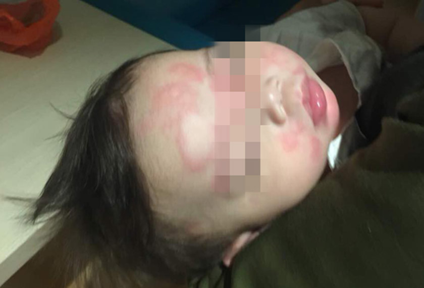 Norseila menasihati ibu bapa yang mempunyai gejala yang sama seperti anaknya untuk mendapatkan rawatan segera di hospital. - Foto Norseila Nawi