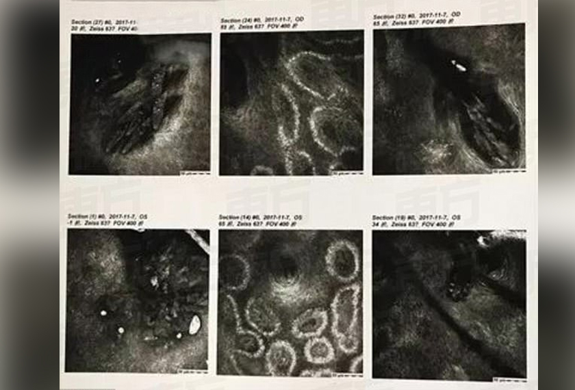 Doktor mengesahkan mata wanita yang dikenali sebagai Wu mempunyai lebih 100 parasit hidup pada bulu matanya. Sumber: Mail Online