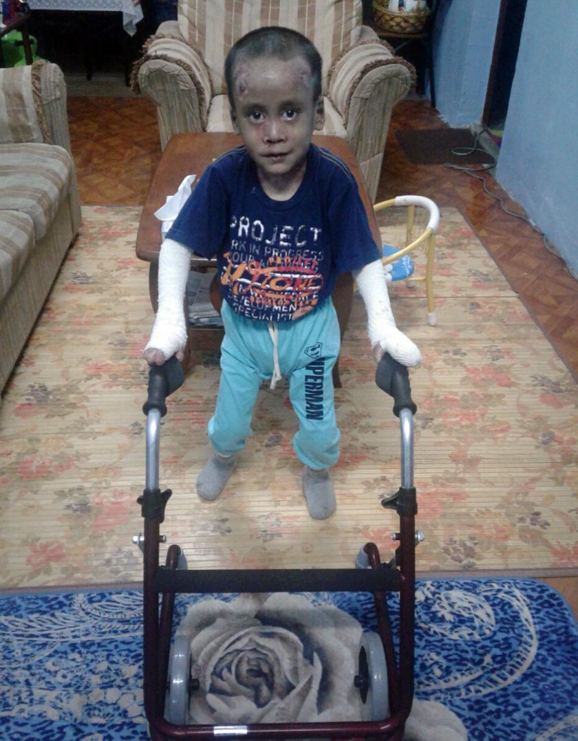 Walaupun Hazreel sudah boleh mula berjalan, namun pesakit EB sepertinya ini akan mengalami lepuh sepanjang hidupnya dan memerlukan penjagaan yang rapi - Foto Noor Halimatun Hashim