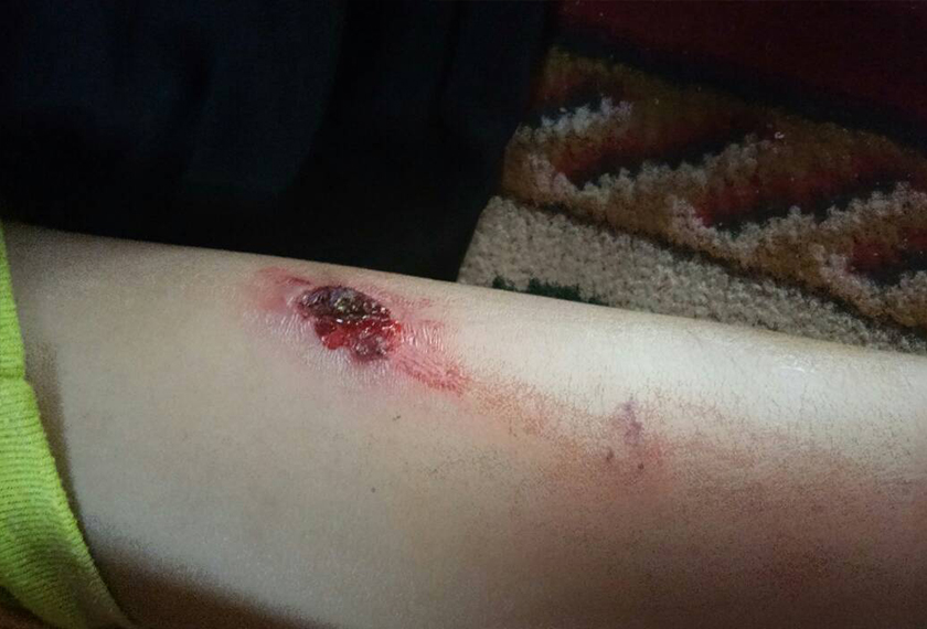 Tangan kanak-kanak malang itu turut cedera dipercayai selepas dicucuh dengan api rokok, dipukul atau ditoreh oleh bapanya.