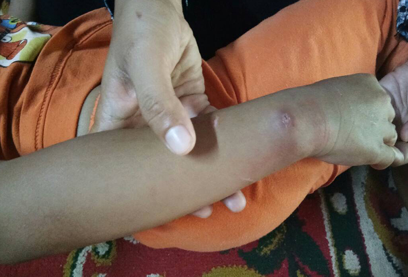 Tangan kanak-kanak malang itu turut cedera dipercayai selepas dicucuh dengan api rokok atau ditoreh oleh bapanya.