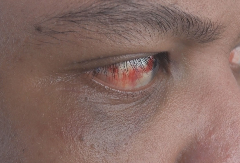 Kecederaan pada mata pelatih yang didakwa akibat dipukul warden pusat pemulihan berkenaan.