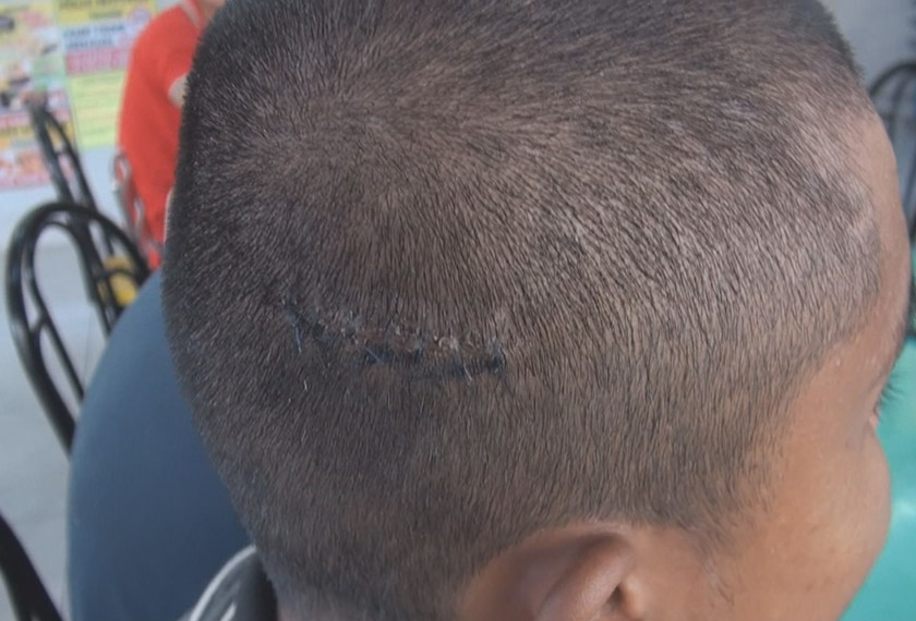 Kesan kecederaan di kepala pelatih yang didakwa akibat dipukul pelatih.