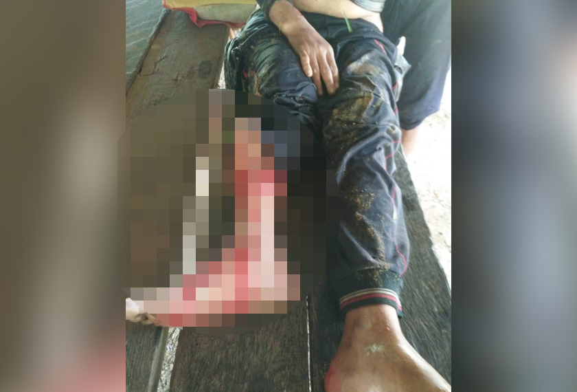 Wanita ini mengalami kecederaan akibat diserang reptilia berkenaan.