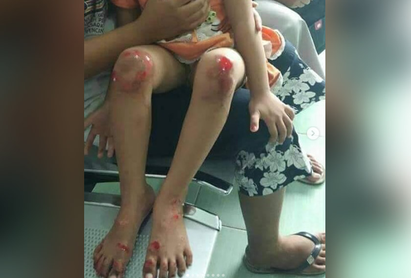 Kanak-kanak tersebut mengalami kecederaan teruk di bahagian lutut dan tapak kakinya. -Instagram @infocegatansukoharjo