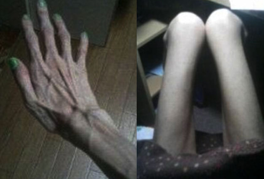 Seorang wanita Jepun mendakwa telah didera oleh datuknya 10 tahun lalu sehingga berat badannya turun mencecah 16.8kg. -Foto Dailymail.com