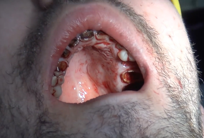Keadaan gigi Michael yang rosak akibat minuman berkabonat berlebihan. Sumber: Youtube/@MeathChronicle