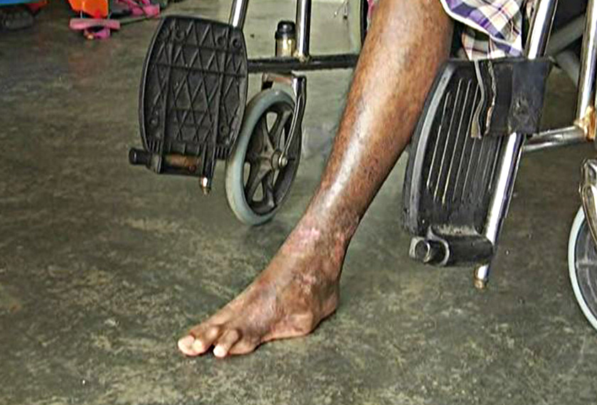 Keadaan kaki Mohd Amir yang dipotong akibat kencing manis. - Astro AWANI