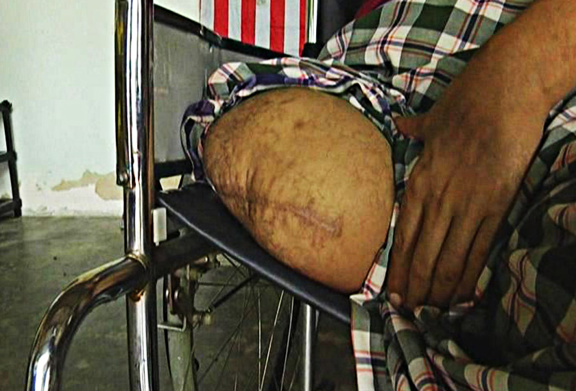 Keadaan kaki Mohd Amir yang dipotong akibat kencing manis. - Astro AWANI