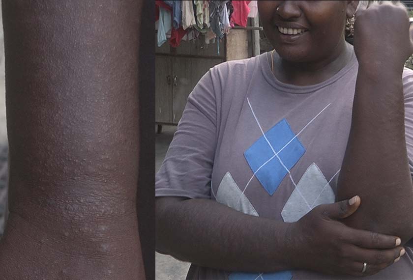 Tangan Malarveli yang mengalami masalah kegatalan teruk, dipercayai kesan penggunaan racun sawit di tempat kerjanya. - Astro AWANI