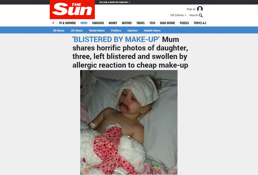 Keadaan Lydia yang terlantar di hospital kerana alahan teruk pada wajahnya - Foto www.thesun.co.uk