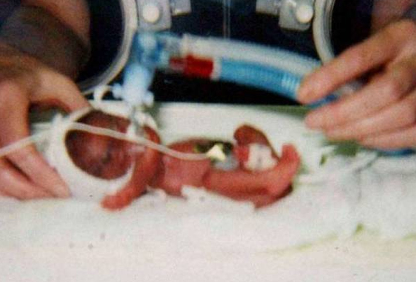 Aliyah dilahirkan dengan berat 340 gram 16 tahun lalu. - Daily Star