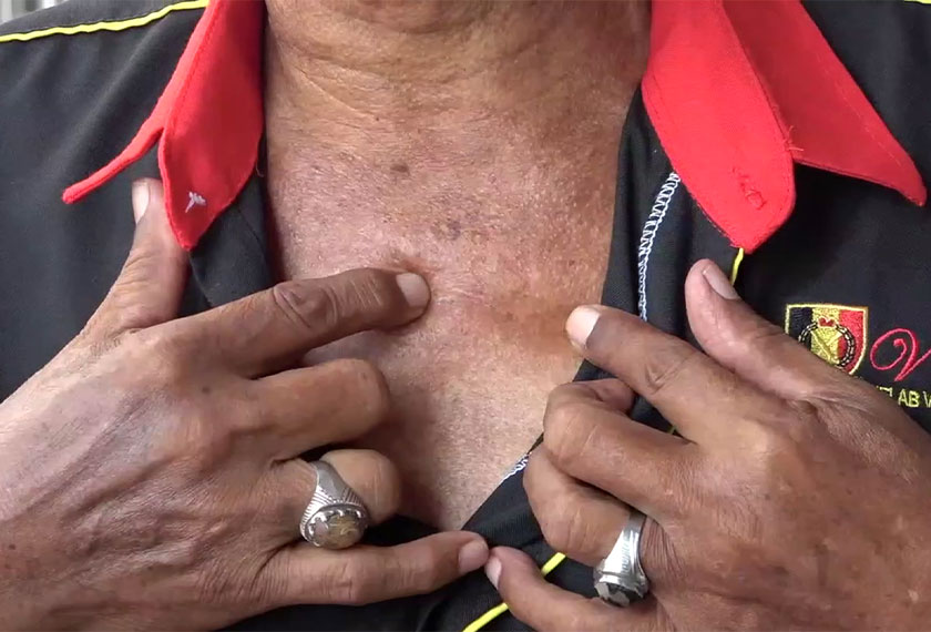 Susulan insiden itu, peluru musuh masih terpahat di tengah-tengah tulang dada warga emas tersebut. - Foto Astro AWANI