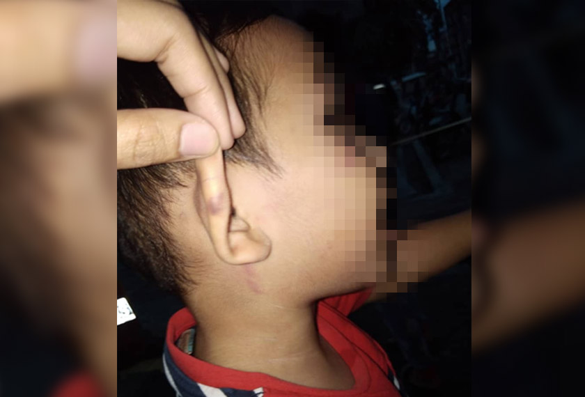 Cuping telinga Dayyan turut menerima kesan akibat penderaan.