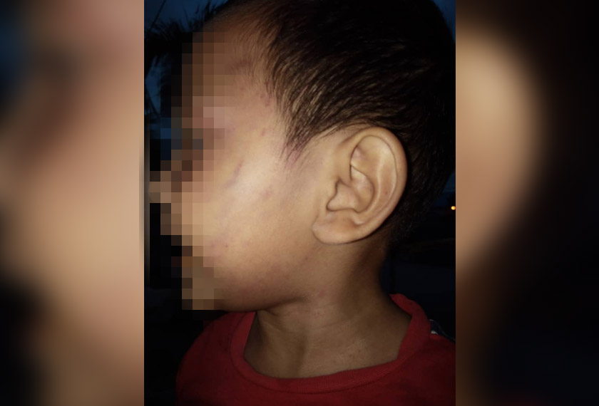 Kesan lebam yang kelihatan di mata Dayyan.