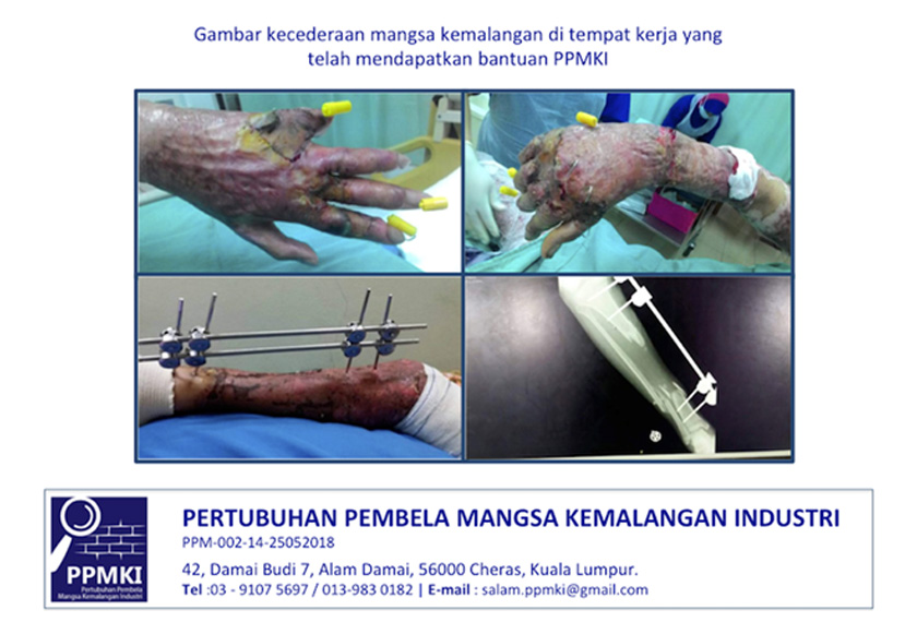 Antara mangsa kemalangan tempat kerja yang mendapat bantuan PPMKI