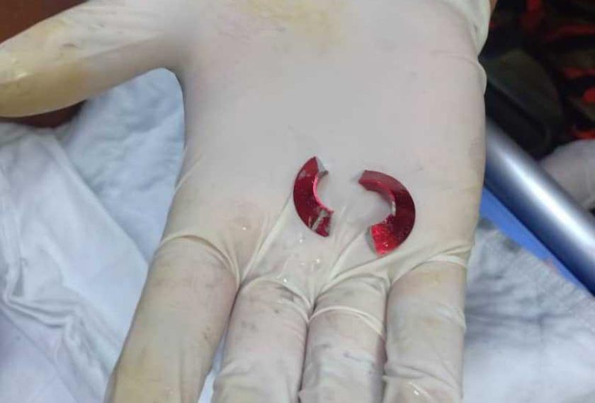 Kanak-kanak lelaki tahan sakit enam jam, jari tersekat cincin.