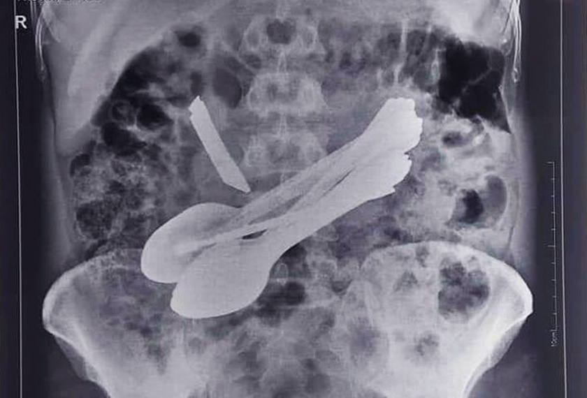 Doktor yang merawat pesakit itu terkejut apabila paparan x-ray menunjukkan ada longgokan objek dalam perut lelaki itu. Foto: Times of India