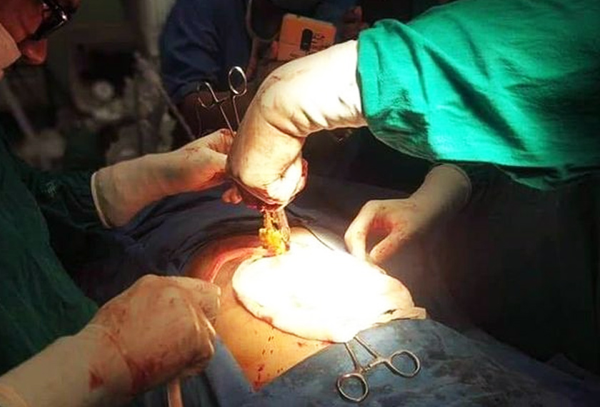 Proses pembedahan terpaksa menggunakan khidmat empat pakar perubatan dan mengambil masa kira-kira empat jam untuk mengeluarkan kesemua objek tersebut. Foto: Times of India