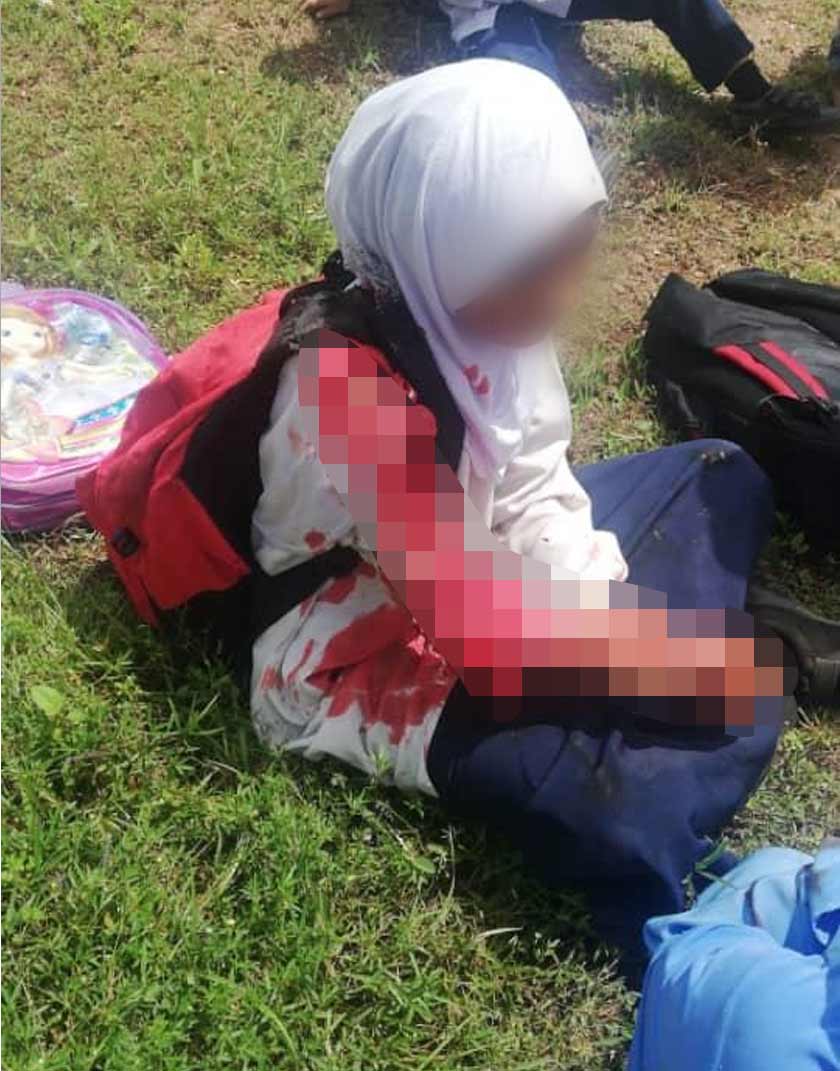  empat pelajar mengalami cedera di bahagian muka, tangan dan kaki dihantar ke Hospital Sultan Abdul Halim, Sungai Petani untuk rawatan lanjut. - Foto Astro AWANI