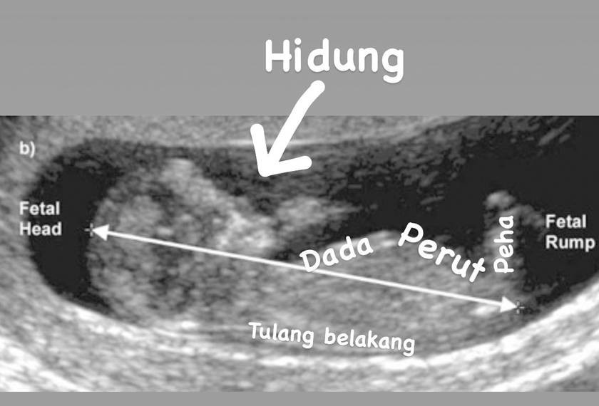 Ketika scan, hidung bayi perlu jelas kelihatan seperti dalam gambar 