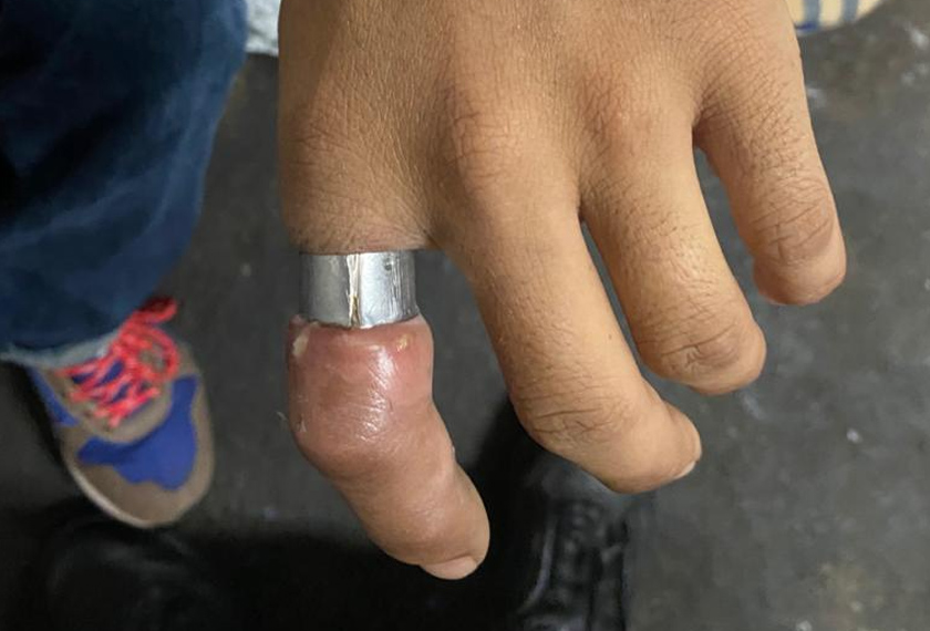 Sebaik tiba di lokasi, bomba dapati cincin masih melekat pada jari telunjuk di tangan kiri lelaki berkenaan. Foto JBPM