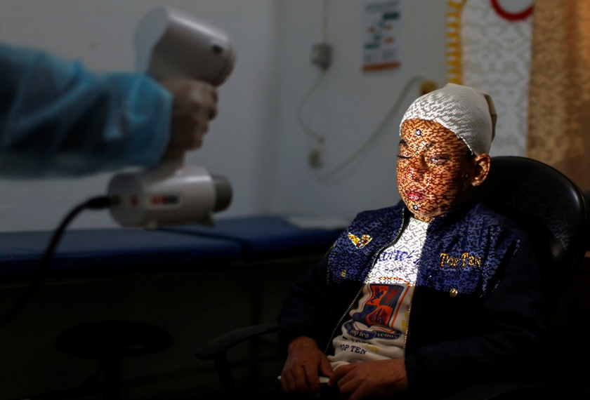 A physiotherapist scans the face of Palestinian boy Ahmed Al-Deeb, who has severe facial burns, to provide him with a 3D transparent face mask, at Medecins Sans Frontieres (MSF)'s clinic in Gaza City. REUTERSpic