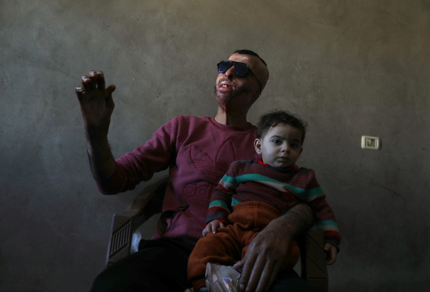 Palestinian man Ahmed Al-Natour, 34, who has severe facial burns and was provided a 3D transparent face mask by Medecins Sans Frontieres (MSF), gestures as he holds his child at his home in Gaza City. REUTERSpic