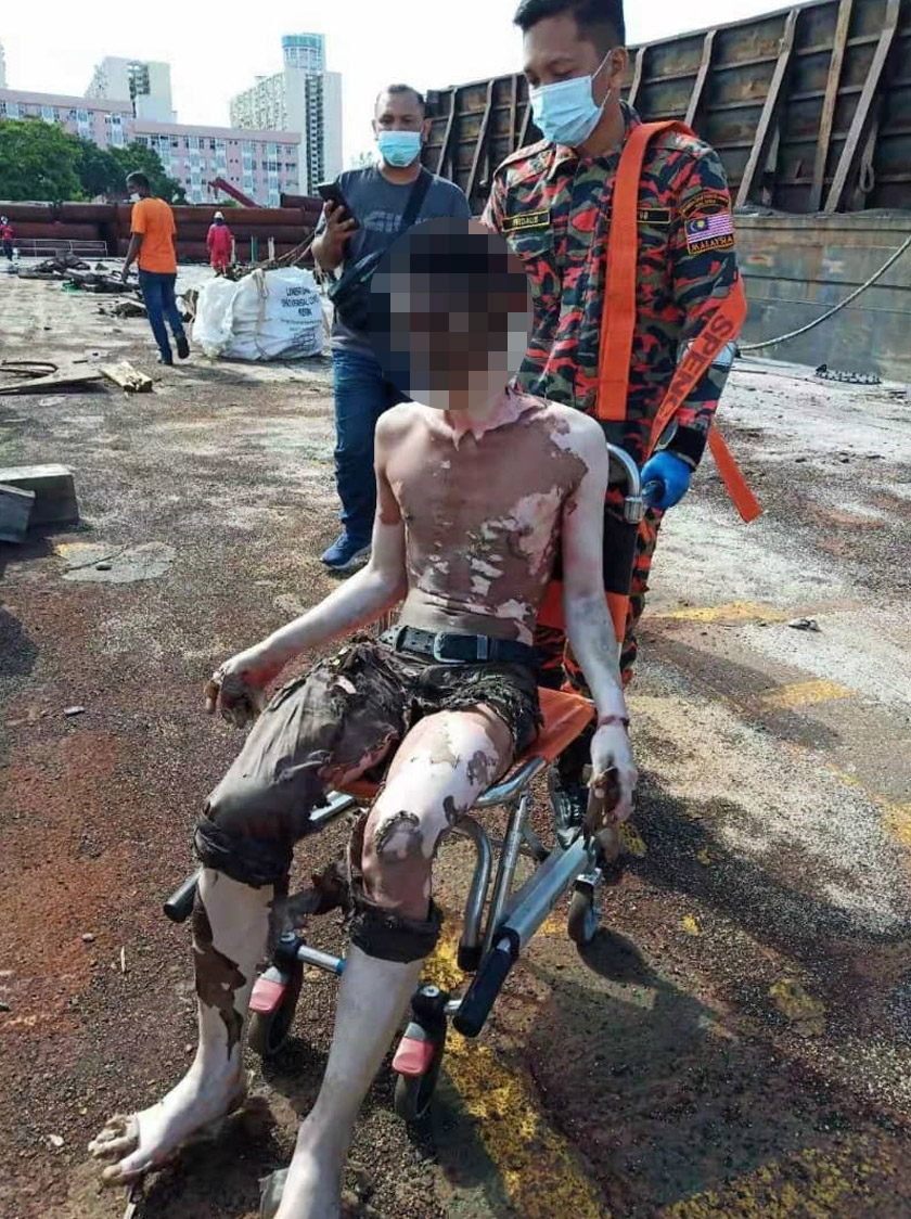   Salah seorang daripada kru yang mengalami kecederaan melecur tahap kedua.