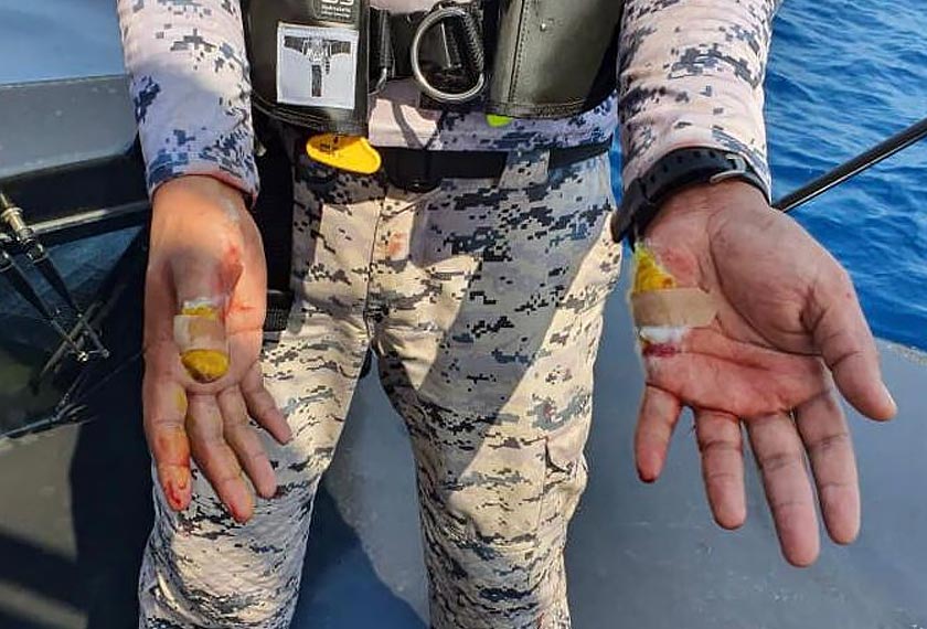 Anggota terbabit mengalami kecederaan di bahagian telapak tangan dan ibu jari.