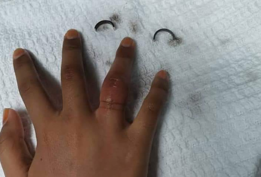  Jari manis tangan kanan pelajar perempuan  mula membengkak, manakala di sebelahnya sebentuk cincin besi yang berjaya ditanggalkan oleh anggota bomba di Balai Bomba Kuala Lipis,  malam tadi. - Foto Bomba Kuala Lipis