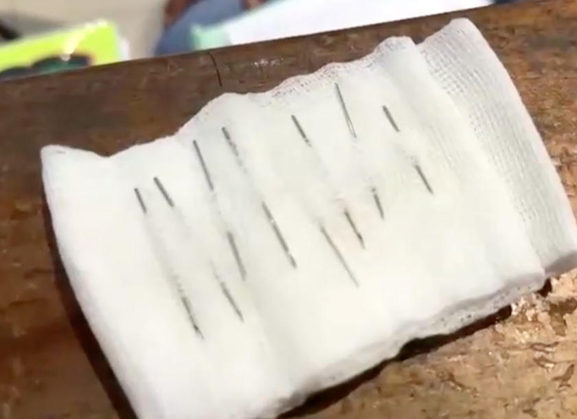 The infant was rushed to a local hospital, where he underwent a two-hour surgery to remove the eight needles in different parts of his stomach and intestinal tract. - Screenshot/REUTERS