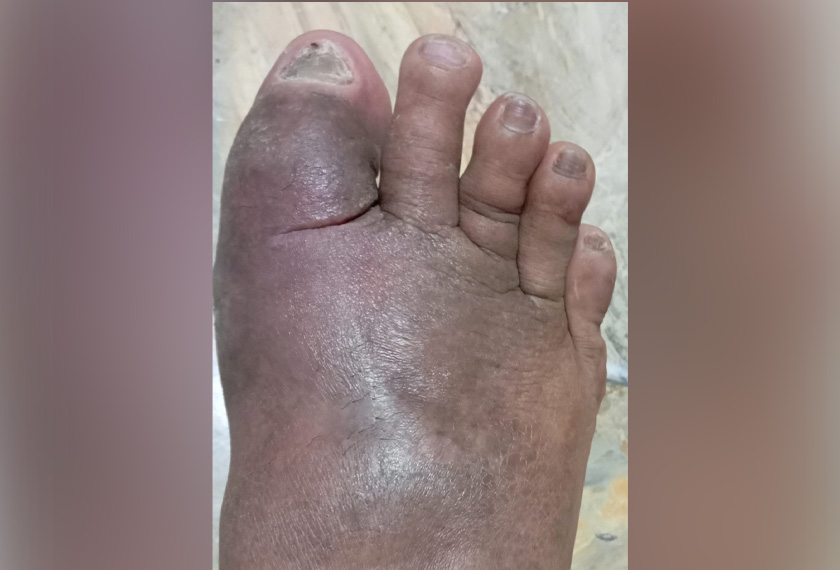 Beginilah keadaan kaki kanan Roy.