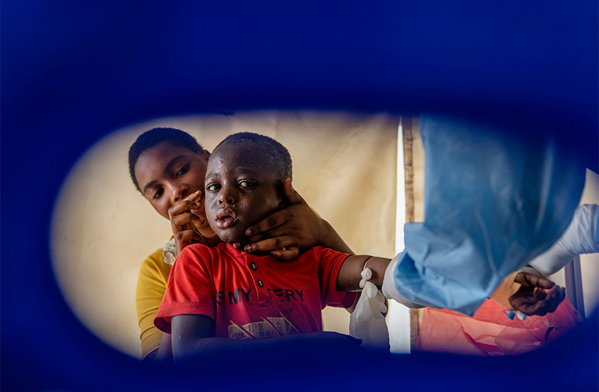 Seorang petugas kesihatan memberi rawatan kepada pesakit mpox di sebuah pusat rawatan di Munigi, Congo. - Foto AP