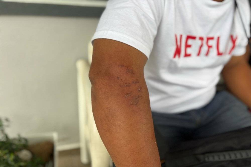 Antara kecederaan melecur di tangan yang dialami Mohd Khairul rentetan peristiwa tersebut. - Foto Sinar Harian